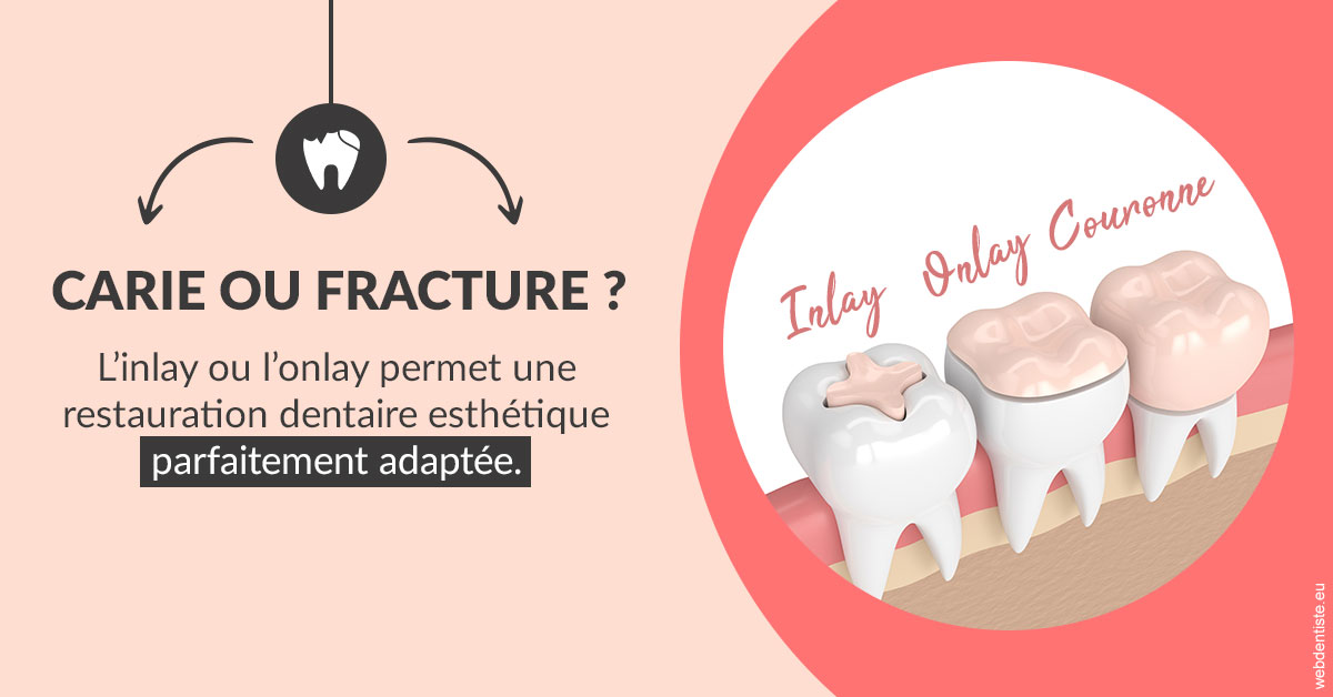 https://dr-marzouk-roland.chirurgiens-dentistes.fr/T2 2023 - Carie ou fracture 2