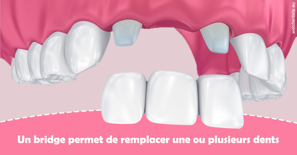 https://dr-marzouk-roland.chirurgiens-dentistes.fr/Bridge remplacer dents 2