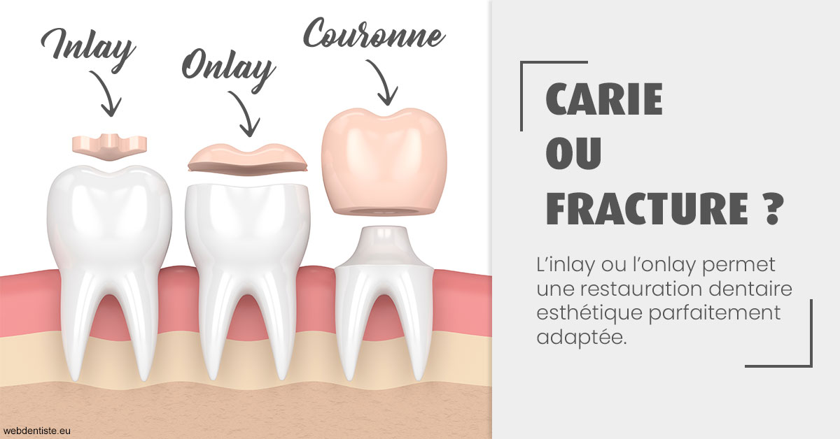 https://dr-marzouk-roland.chirurgiens-dentistes.fr/T2 2023 - Carie ou fracture 1