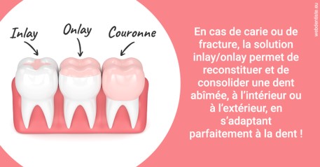 https://dr-marzouk-roland.chirurgiens-dentistes.fr/L'INLAY ou l'ONLAY 2