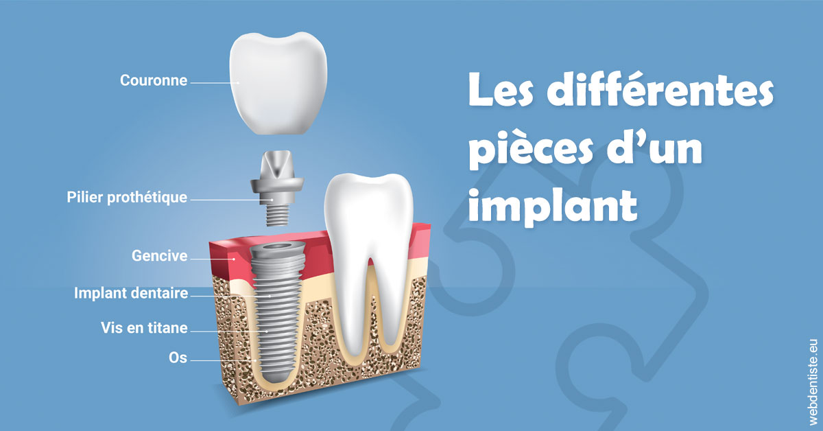 https://dr-marzouk-roland.chirurgiens-dentistes.fr/Les différentes pièces d’un implant 1